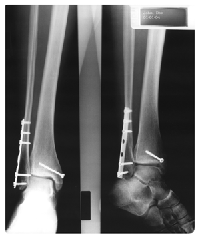 X-ray Duplicates